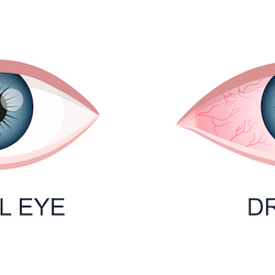 Az Optometristák szerepe száraz szem szindróma esetén