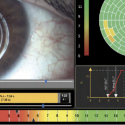 Az Optometristák szerepe száraz szem szindróma esetén