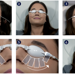 Az Optometristák szerepe száraz szem szindróma esetén