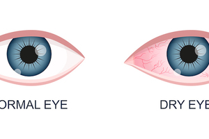 Az Optometristák szerepe száraz szem szindróma esetén
